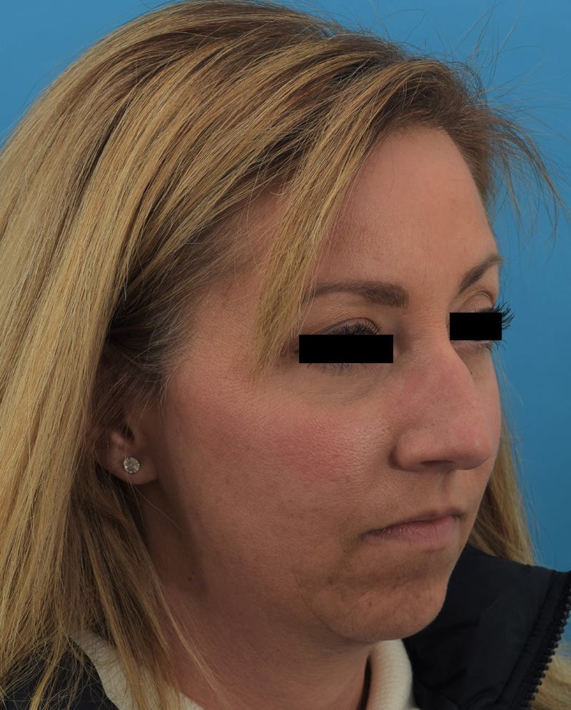 Rhinoplasty Before & After Gallery - Patient 144554833 - Image 3