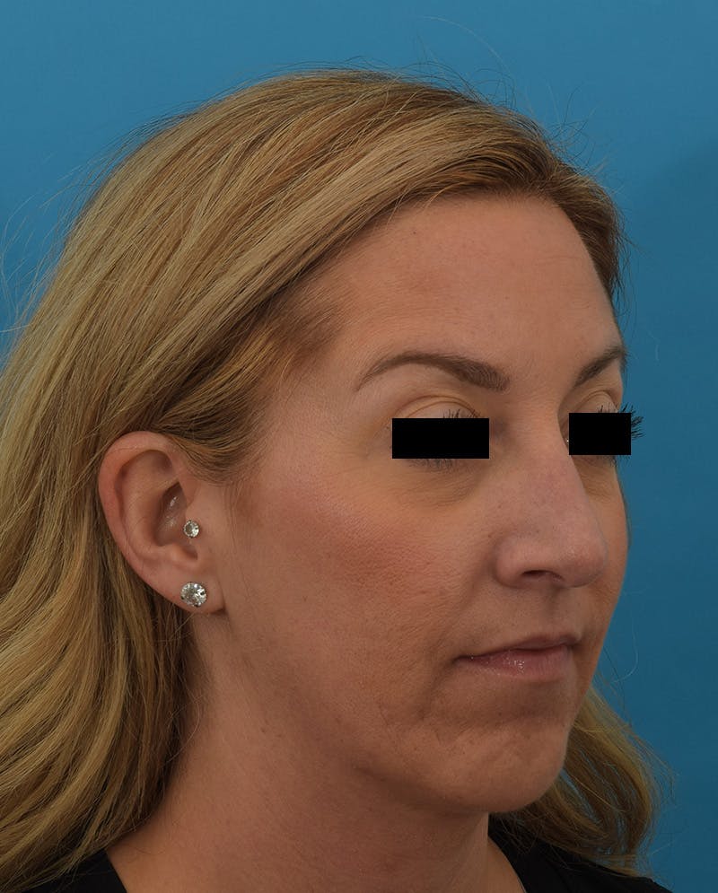 Rhinoplasty Before & After Gallery - Patient 144554833 - Image 4