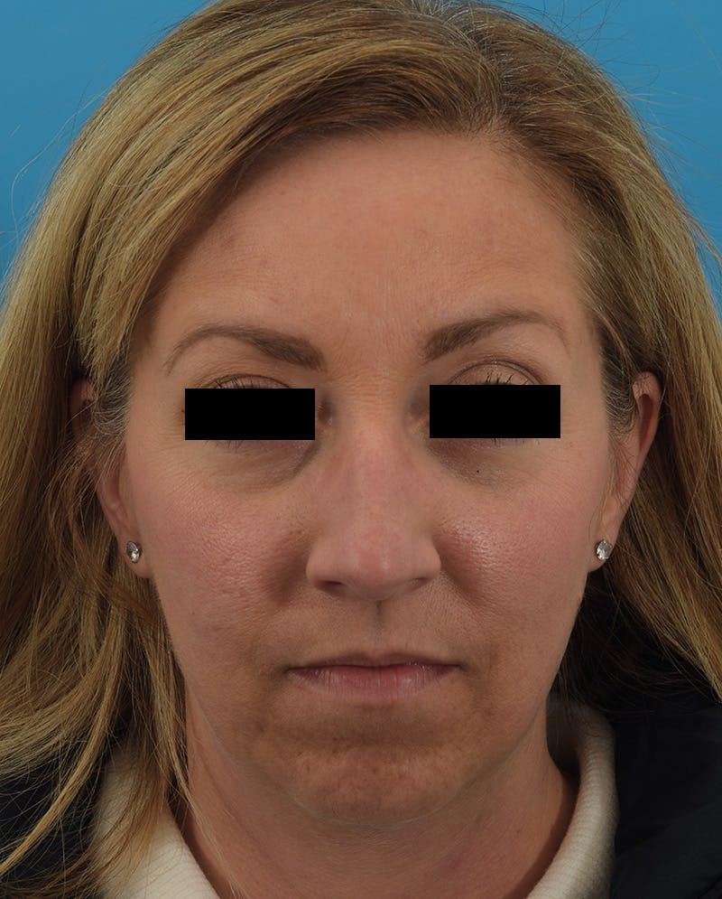 Rhinoplasty Before & After Gallery - Patient 144554833 - Image 5