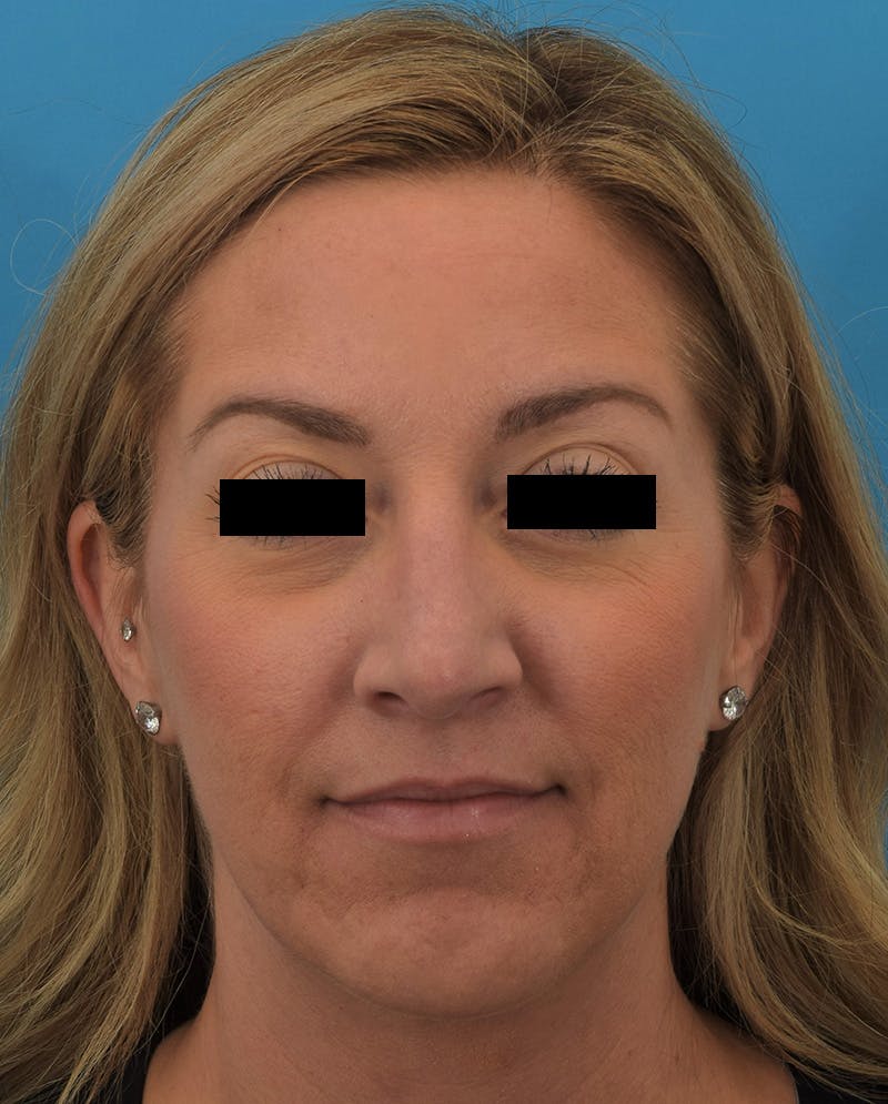 Rhinoplasty Before & After Gallery - Patient 144554833 - Image 6