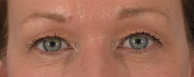 Blepharoplasty Before & After Gallery - Patient 144554875 - Image 1