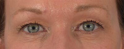 Blepharoplasty Before & After Gallery - Patient 144554875 - Image 1