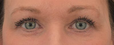 Blepharoplasty Before & After Gallery - Patient 144554875 - Image 2