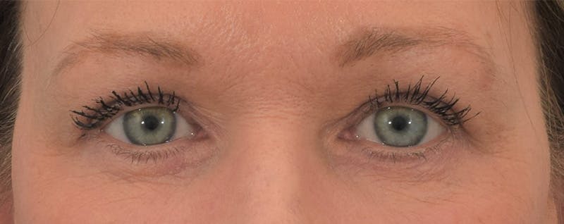 Blepharoplasty Before & After Gallery - Patient 144554875 - Image 2