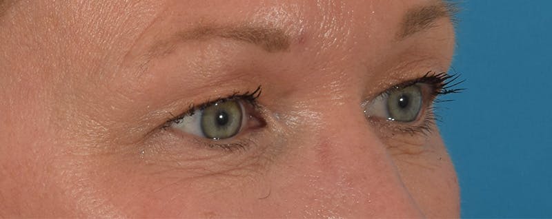 Blepharoplasty Before & After Gallery - Patient 144554875 - Image 3