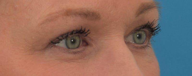 Blepharoplasty Before & After Gallery - Patient 144554875 - Image 4