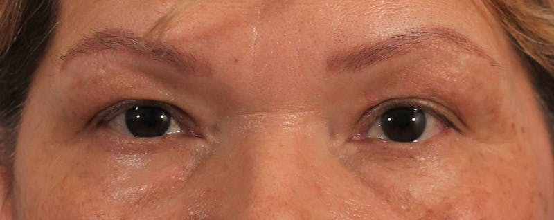 Blepharoplasty Before & After Gallery - Patient 145103283 - Image 1