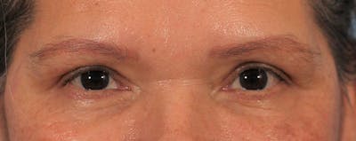 Blepharoplasty Before & After Gallery - Patient 145103283 - Image 2