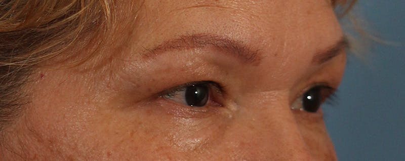 Blepharoplasty Before & After Gallery - Patient 145103283 - Image 3