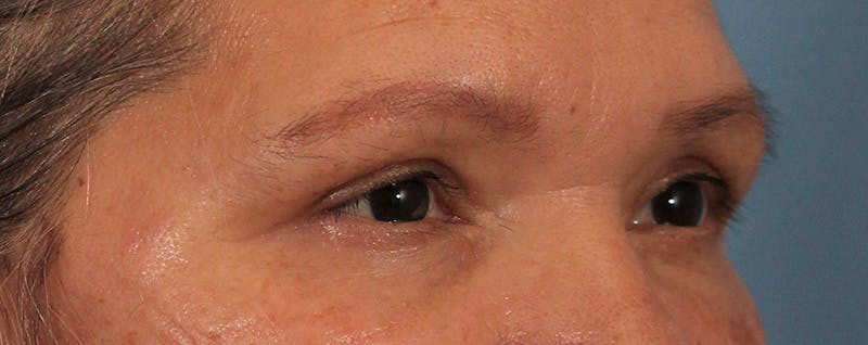 Blepharoplasty Before & After Gallery - Patient 145103283 - Image 4