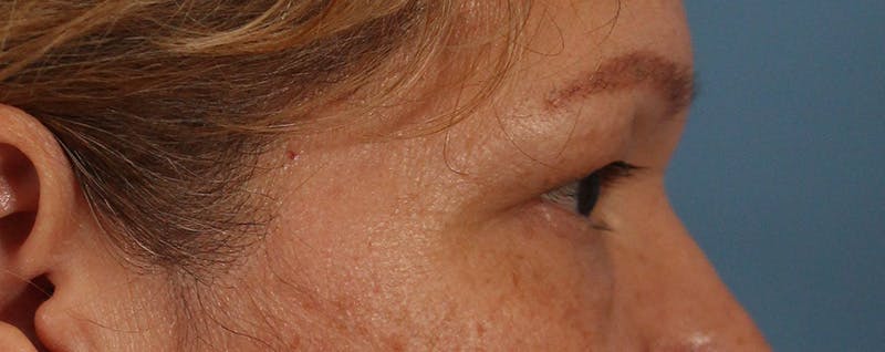 Blepharoplasty Before & After Gallery - Patient 145103283 - Image 5