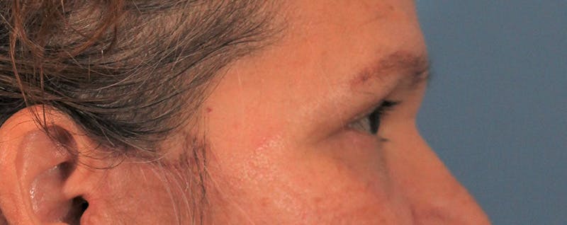 Blepharoplasty Before & After Gallery - Patient 145103283 - Image 6