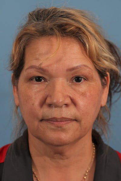 Facelift/Neck Lift Before & After Gallery - Patient 145103293 - Image 1