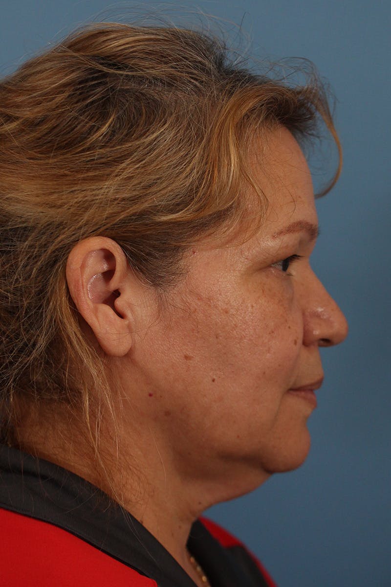 Facelift/Neck Lift Before & After Gallery - Patient 145103293 - Image 5