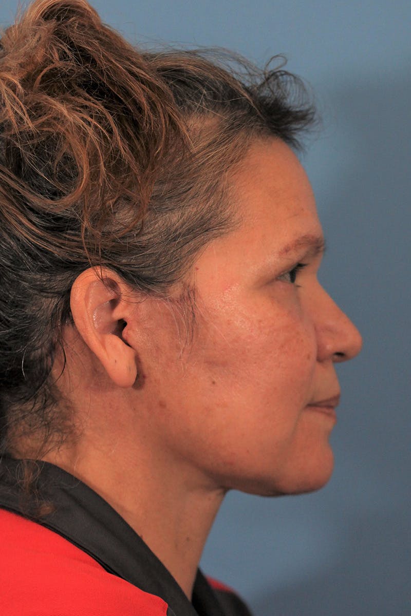 Facelift/Neck Lift Before & After Gallery - Patient 145103293 - Image 6