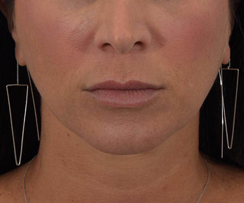 Lip Augmentation  Before & After Gallery - Patient 145103296 - Image 1