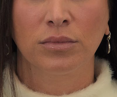 Lip Augmentation  Before & After Gallery - Patient 145103296 - Image 2