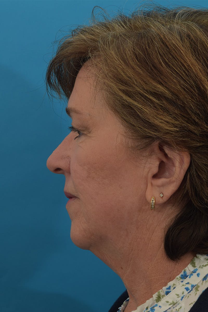 Facelift/Neck Lift Before & After Gallery - Patient 146669617 - Image 5