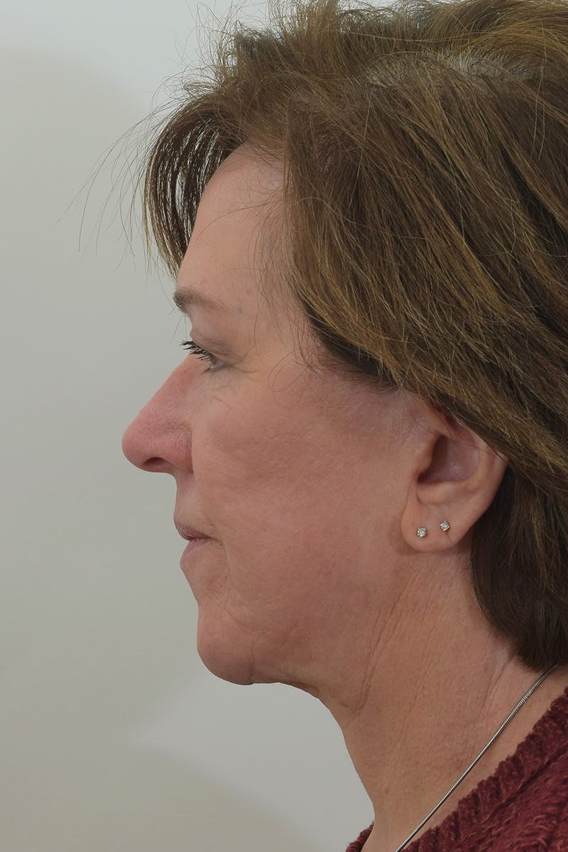 Facelift/Neck Lift Before & After Gallery - Patient 146669617 - Image 6