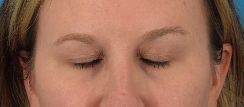 Blepharoplasty Before & After Gallery - Patient 146779988 - Image 3