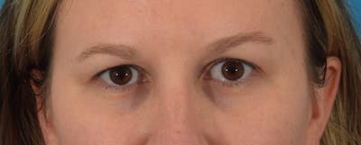 Blepharoplasty Before & After Gallery - Patient 146779988 - Image 1