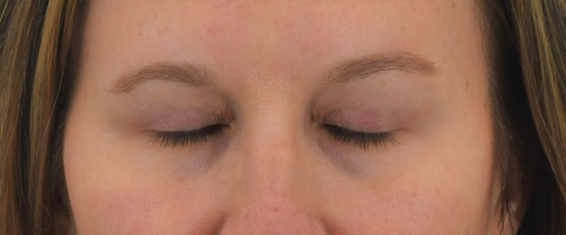 Blepharoplasty Before & After Gallery - Patient 146779988 - Image 4