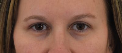Blepharoplasty Before & After Gallery - Patient 146779988 - Image 2