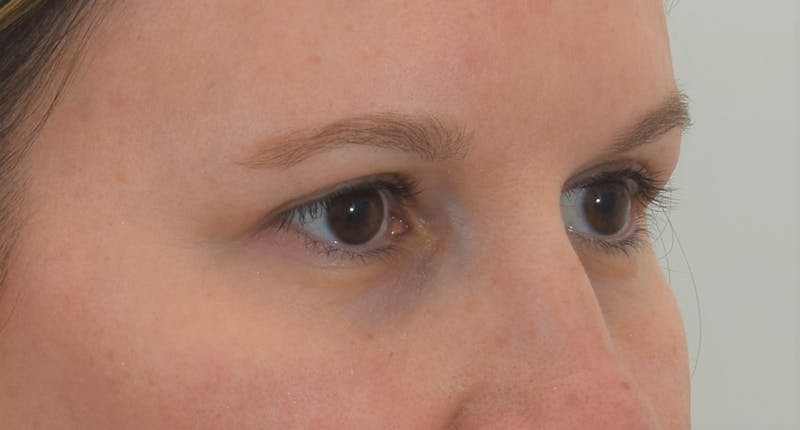 Blepharoplasty Before & After Gallery - Patient 146779988 - Image 6