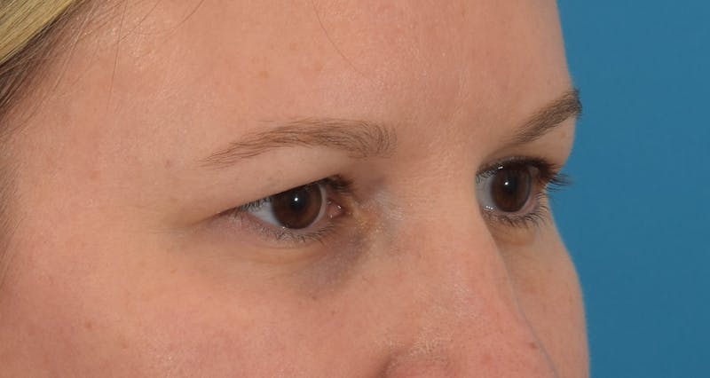 Blepharoplasty Before & After Gallery - Patient 146779988 - Image 5
