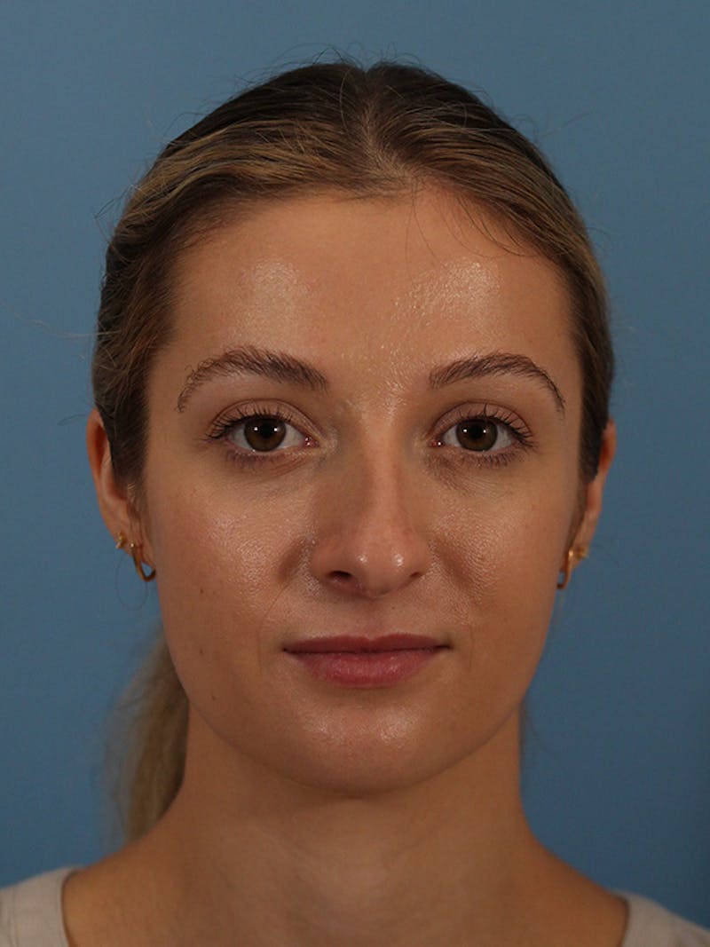 Rhinoplasty Before & After Gallery - Patient 146780015 - Image 3