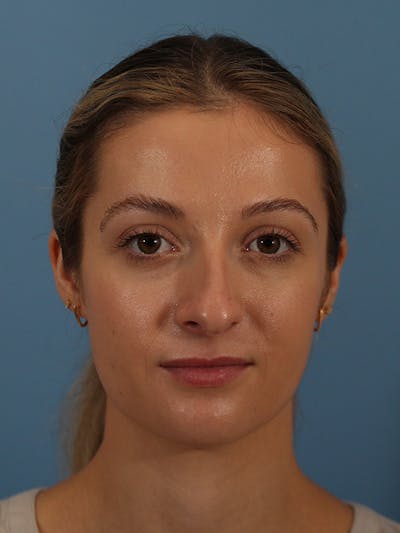 Rhinoplasty Before & After Gallery - Patient 146780015 - Image 1