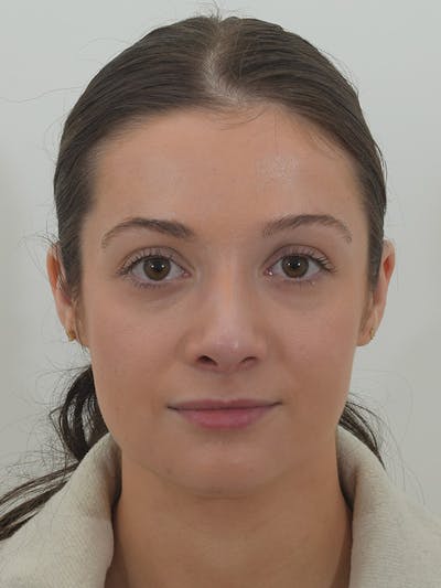 Rhinoplasty Before & After Gallery - Patient 146780015 - Image 2