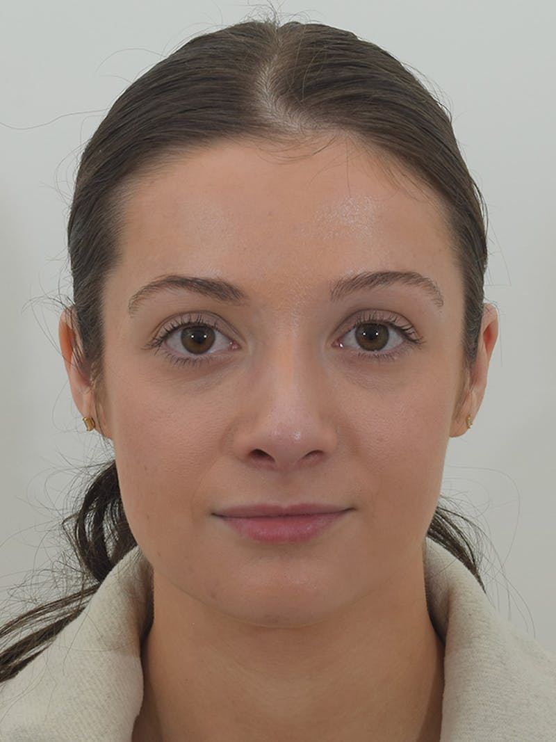 Rhinoplasty Before & After Gallery - Patient 146780015 - Image 4