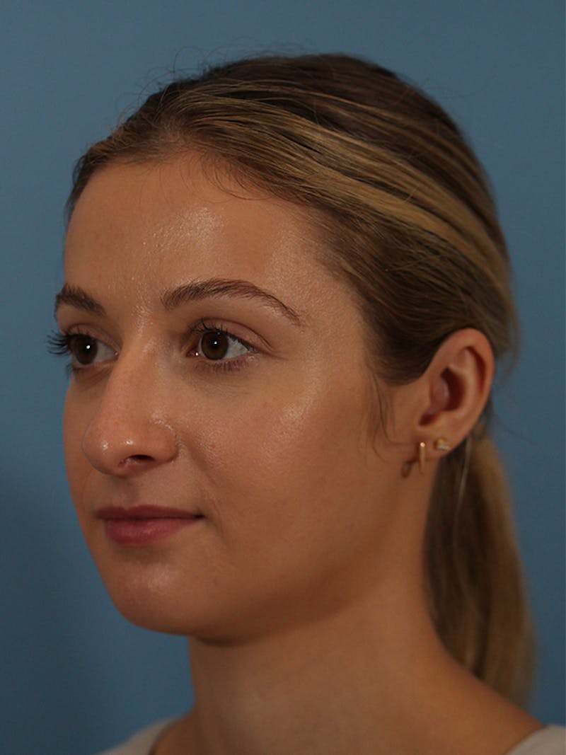 Rhinoplasty Before & After Gallery - Patient 146780015 - Image 5