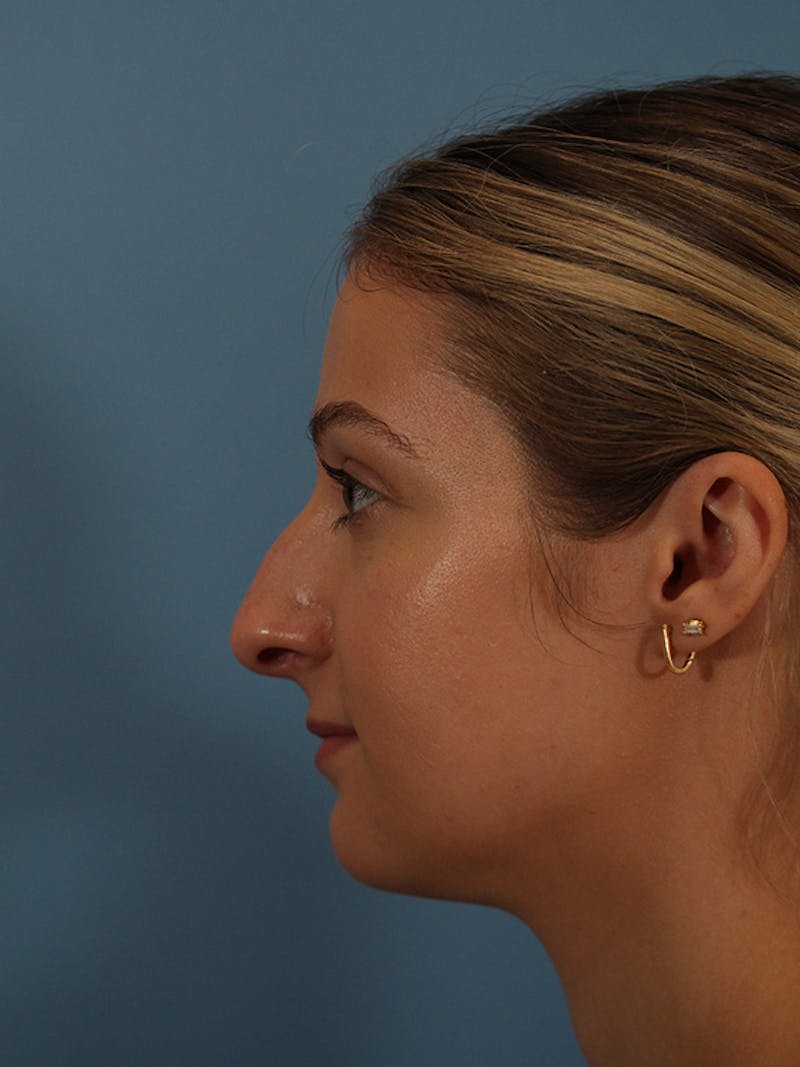 Rhinoplasty Before & After Gallery - Patient 146780015 - Image 7