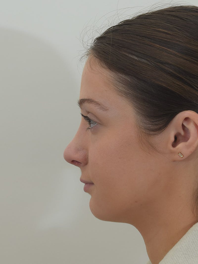 Rhinoplasty Before & After Gallery - Patient 146780015 - Image 6