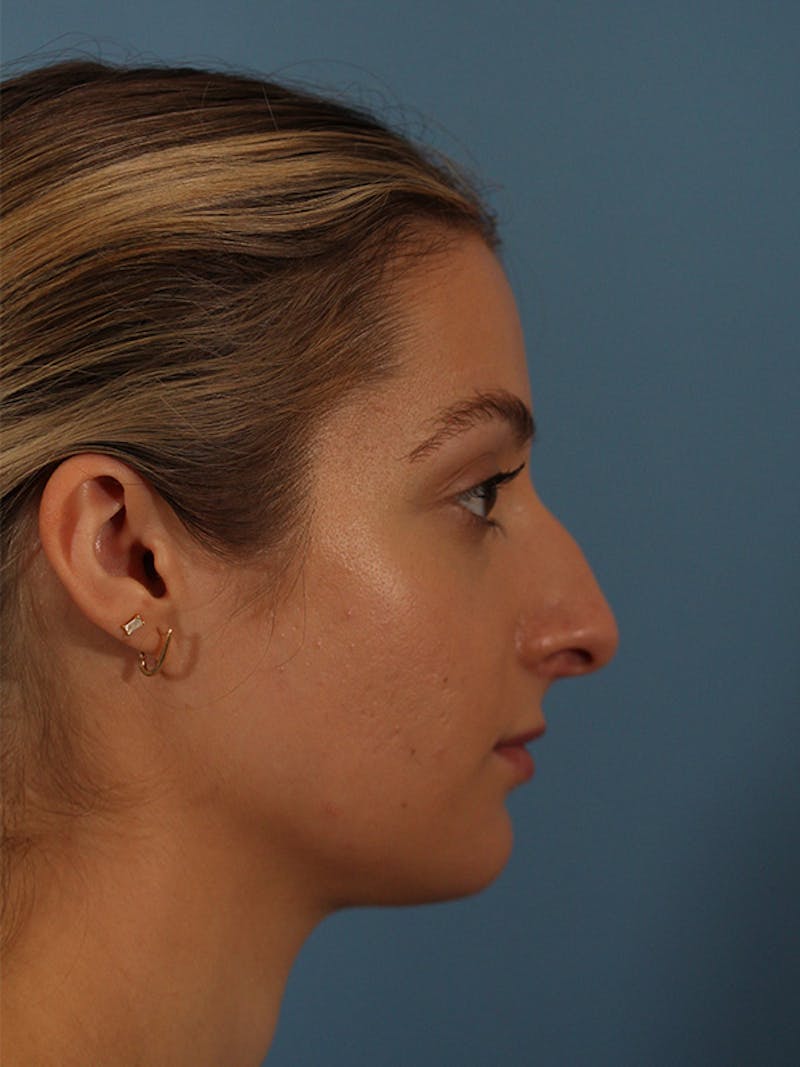 Rhinoplasty Before & After Gallery - Patient 146780015 - Image 1