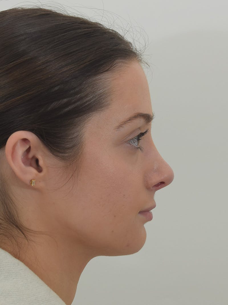 Rhinoplasty Before & After Gallery - Patient 146780015 - Image 2