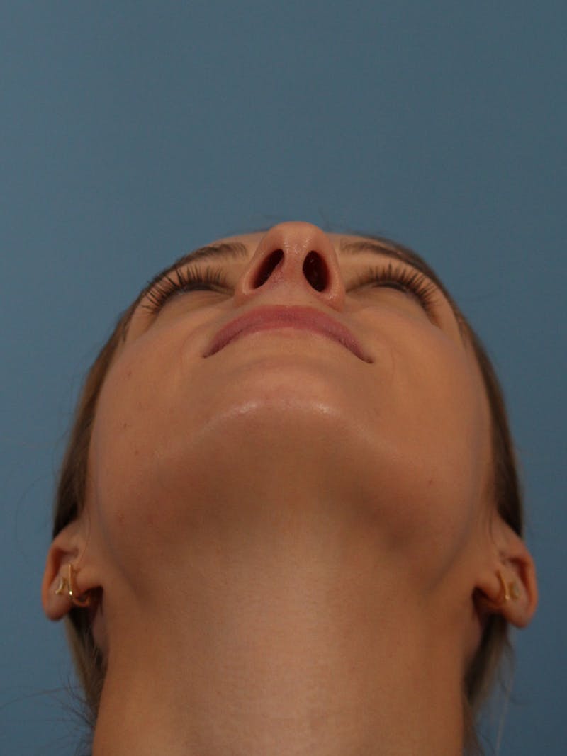 Rhinoplasty Before & After Gallery - Patient 146780015 - Image 9