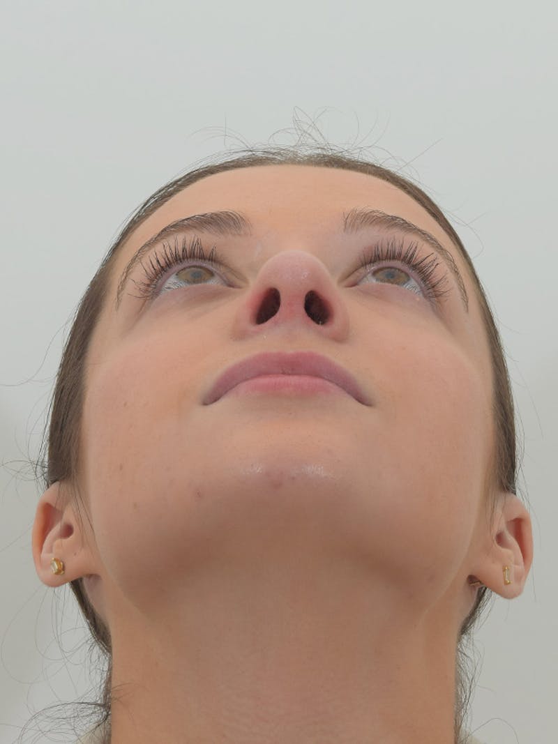 Rhinoplasty Before & After Gallery - Patient 146780015 - Image 10