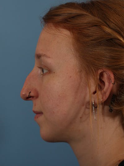 Rhinoplasty Before & After Gallery - Patient 146804592 - Image 1