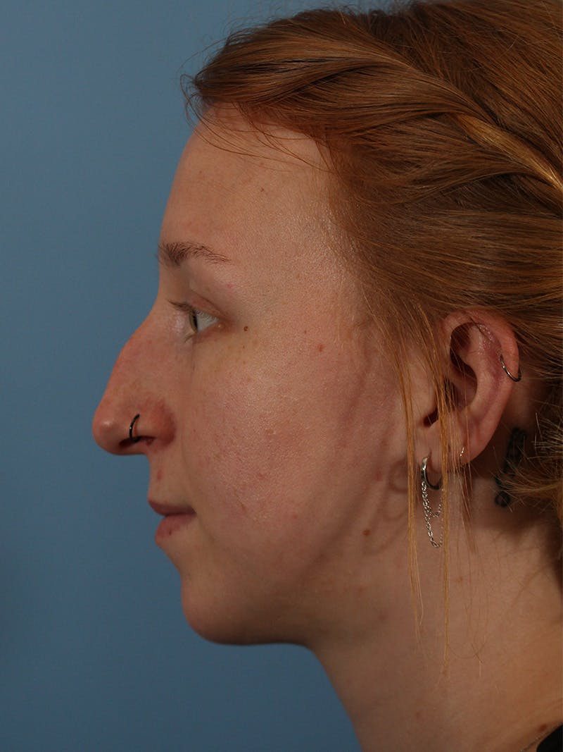 Rhinoplasty Before & After Gallery - Patient 146804592 - Image 1