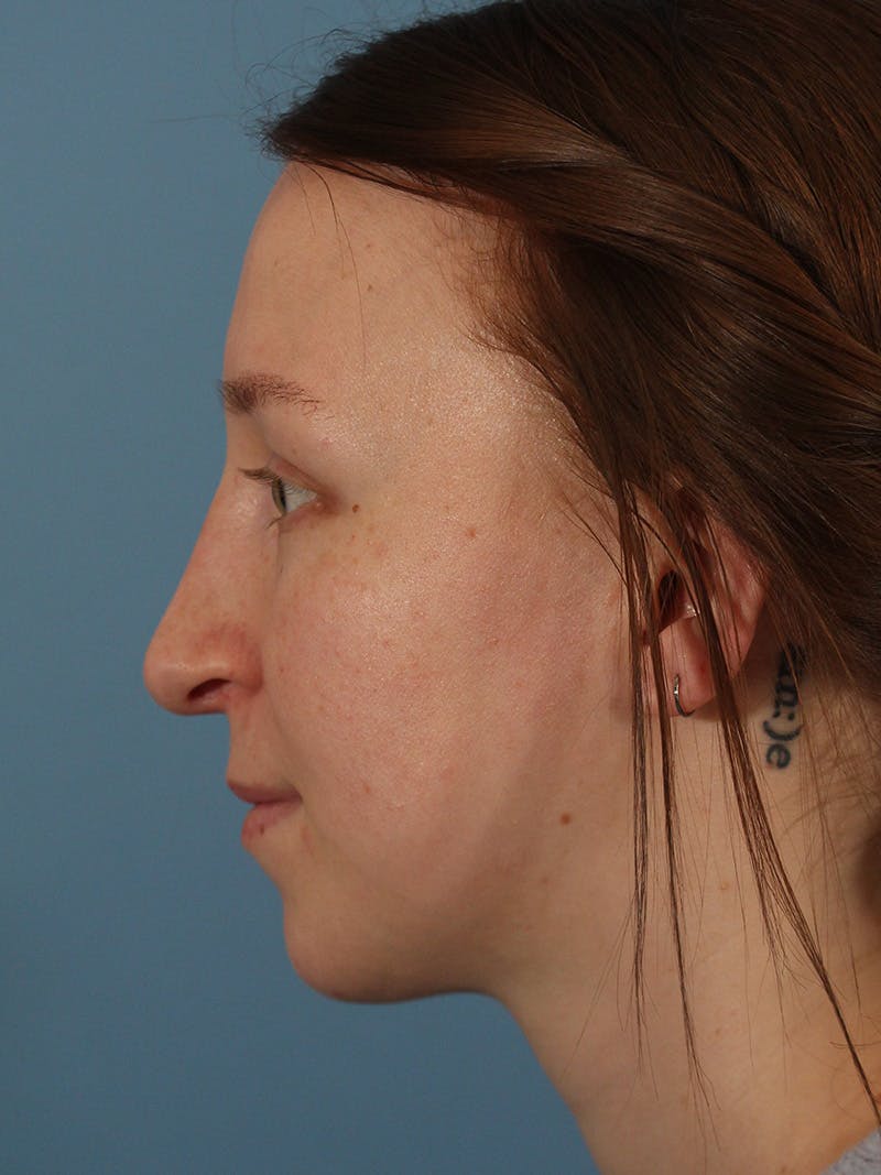 Rhinoplasty Before & After Gallery - Patient 146804592 - Image 2