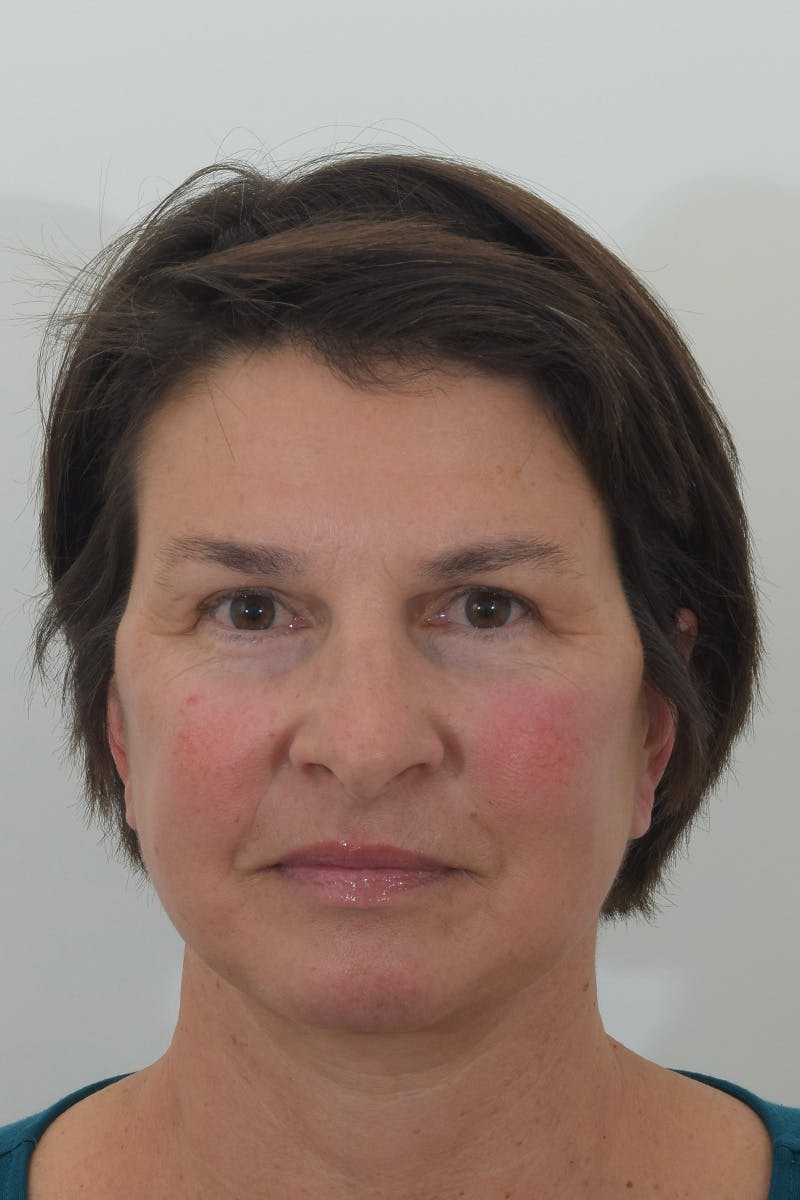 Blepharoplasty Before & After Gallery - Patient 148022917 - Image 2