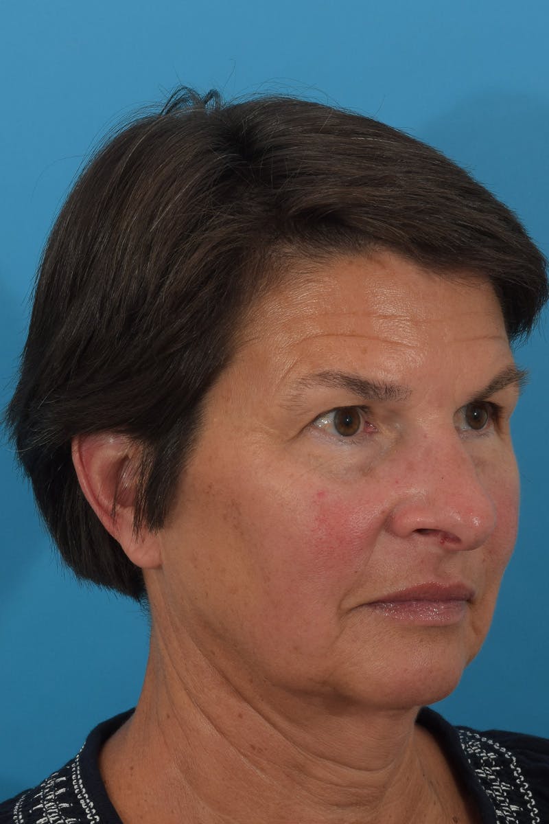 Facelift/Neck Lift Before & After Gallery - Patient 148022915 - Image 3