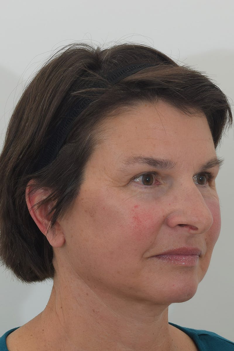 Brow Lift Before & After Gallery - Patient 148022916 - Image 4
