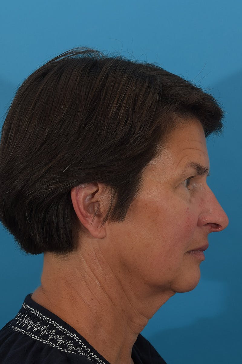 Facelift/Neck Lift Before & After Gallery - Patient 148022915 - Image 5