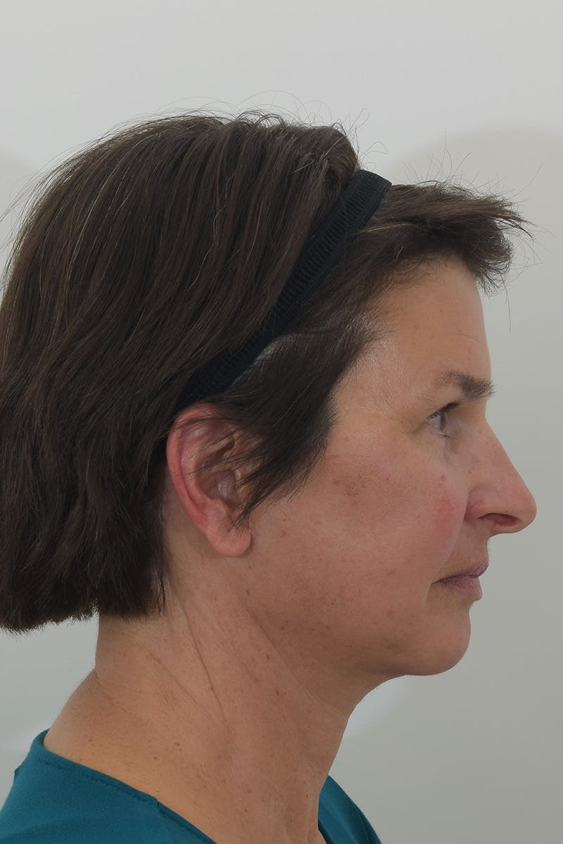 Brow Lift Before & After Gallery - Patient 148022916 - Image 6