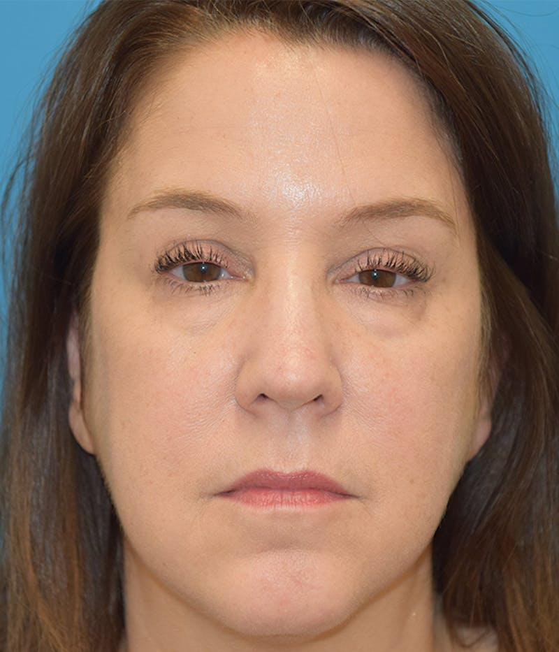 Blepharoplasty Before & After Gallery - Patient 148148045 - Image 1