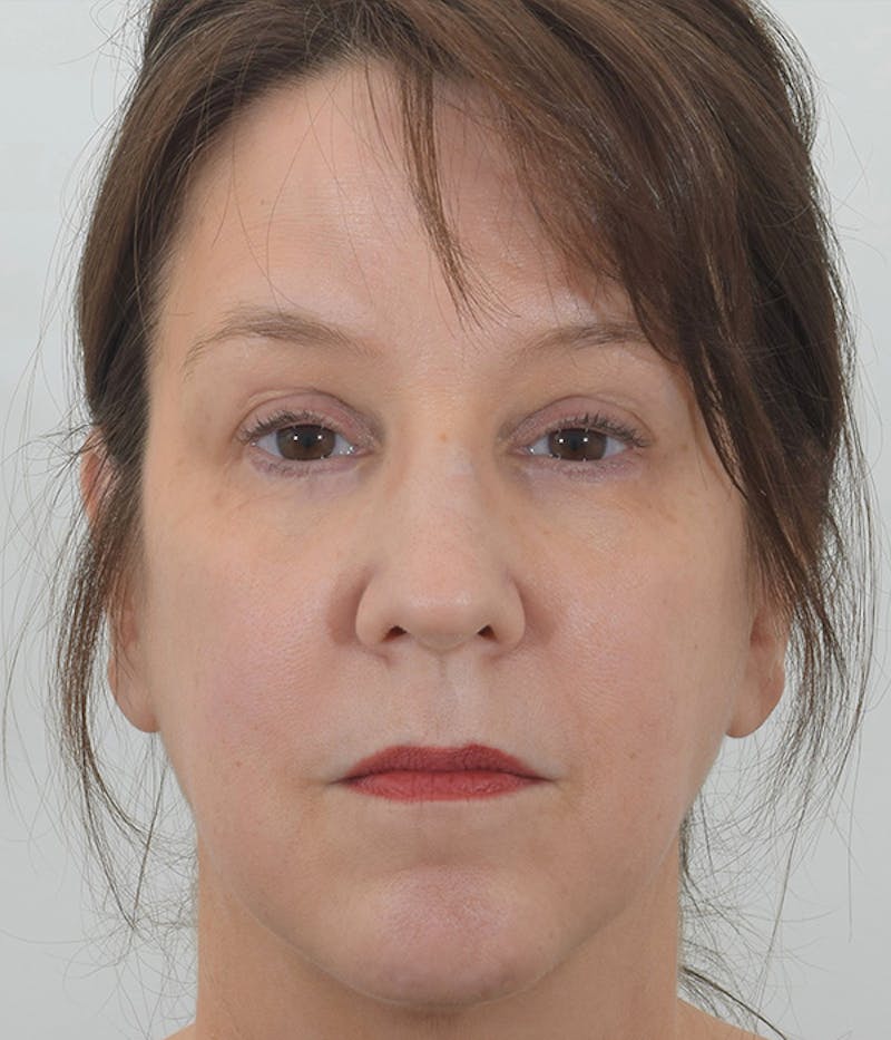 Blepharoplasty Before & After Gallery - Patient 148148045 - Image 2